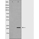 DF7042 at 1/100 staining Human liver cancer tissue by IHC-P. The sample was formaldehyde fixed and a heat mediated antigen retrieval step in citrate buffer was performed. The sample was then blocked and incubated with the antibody for 1.5 hours at 22¡ãC. An HRP conjugated goat anti-rabbit antibody was used as the secondary