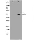 DF7047 at 1/100 staining Human liver cancer tissue by IHC-P. The sample was formaldehyde fixed and a heat mediated antigen retrieval step in citrate buffer was performed. The sample was then blocked and incubated with the antibody for 1.5 hours at 22¡ãC. An HRP conjugated goat anti-rabbit antibody was used as the secondary