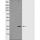 DF7057 at 1/100 staining Human Head and neck cancer tissue by IHC-P. The sample was formaldehyde fixed and a heat mediated antigen retrieval step in citrate buffer was performed. The sample was then blocked and incubated with the antibody for 1.5 hours at 22¡ãC. An HRP conjugated goat anti-rabbit antibody was used as the secondary