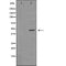 DF7079 at 1/100 staining Human liver cancer tissue by IHC-P. The sample was formaldehyde fixed and a heat mediated antigen retrieval step in citrate buffer was performed. The sample was then blocked and incubated with the antibody for 1.5 hours at 22¡ãC. An HRP conjugated goat anti-rabbit antibody was used as the secondary