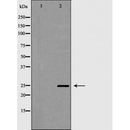 DF7080 at 1/100 staining Human breast cancer tissue by IHC-P. The sample was formaldehyde fixed and a heat mediated antigen retrieval step in citrate buffer was performed. The sample was then blocked and incubated with the antibody for 1.5 hours at 22¡ãC. An HRP conjugated goat anti-rabbit antibody was used as the secondary