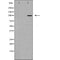 DF7101 at 1/100 staining Human brain cancer tissue by IHC-P. The sample was formaldehyde fixed and a heat mediated antigen retrieval step in citrate buffer was performed. The sample was then blocked and incubated with the antibody for 1.5 hours at 22¡ãC. An HRP conjugated goat anti-rabbit antibody was used as the secondary