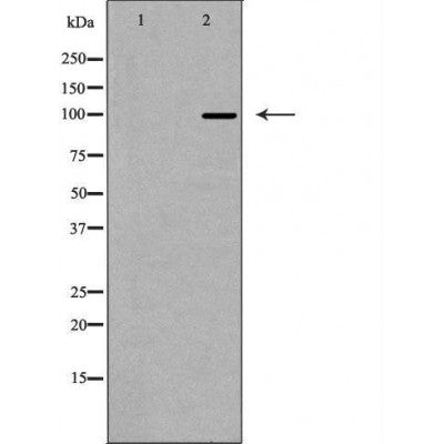 DF7101 at 1/100 staining Human brain cancer tissue by IHC-P. The sample was formaldehyde fixed and a heat mediated antigen retrieval step in citrate buffer was performed. The sample was then blocked and incubated with the antibody for 1.5 hours at 22¡ãC. An HRP conjugated goat anti-rabbit antibody was used as the secondary