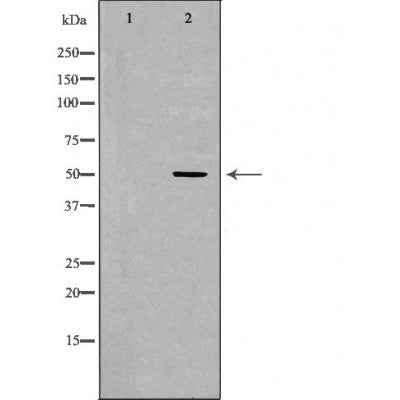 DF7104 at 1/100 staining Human liver cancer tissue by IHC-P. The sample was formaldehyde fixed and a heat mediated antigen retrieval step in citrate buffer was performed. The sample was then blocked and incubated with the antibody for 1.5 hours at 22¡ãC. An HRP conjugated goat anti-rabbit antibody was used as the secondary