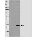 DF7115 at 1/100 staining Human liver cancer tissue by IHC-P. The sample was formaldehyde fixed and a heat mediated antigen retrieval step in citrate buffer was performed. The sample was then blocked and incubated with the antibody for 1.5 hours at 22¡ãC. An HRP conjugated goat anti-rabbit antibody was used as the secondary