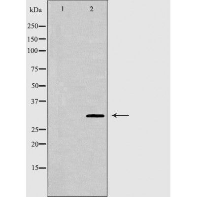DF7116 at 1/100 staining Human liver cancer tissue by IHC-P. The sample was formaldehyde fixed and a heat mediated antigen retrieval step in citrate buffer was performed. The sample was then blocked and incubated with the antibody for 1.5 hours at 22¡ãC. An HRP conjugated goat anti-rabbit antibody was used as the secondary