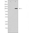 DF7121 at 1/100 staining Human liver cancer tissue by IHC-P. The sample was formaldehyde fixed and a heat mediated antigen retrieval step in citrate buffer was performed. The sample was then blocked and incubated with the antibody for 1.5 hours at 22¡ãC. An HRP conjugated goat anti-rabbit antibody was used as the secondary