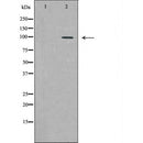 DF7125 at 1/100 staining Human liver cancer tissue by IHC-P. The sample was formaldehyde fixed and a heat mediated antigen retrieval step in citrate buffer was performed. The sample was then blocked and incubated with the antibody for 1.5 hours at 22¡ãC. An HRP conjugated goat anti-rabbit antibody was used as the secondary
