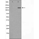 DF7160 at 1/100 staining Human liver cancer tissue by IHC-P. The sample was formaldehyde fixed and a heat mediated antigen retrieval step in citrate buffer was performed. The sample was then blocked and incubated with the antibody for 1.5 hours at 22¡ãC. An HRP conjugated goat anti-rabbit antibody was used as the secondary