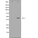 DF7163 at 1/100 staining Human liver cancer tissue by IHC-P. The sample was formaldehyde fixed and a heat mediated antigen retrieval step in citrate buffer was performed. The sample was then blocked and incubated with the antibody for 1.5 hours at 22¡ãC. An HRP conjugated goat anti-rabbit antibody was used as the secondary