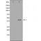 DF7164 at 1/100 staining Human liver cancer tissue by IHC-P. The sample was formaldehyde fixed and a heat mediated antigen retrieval step in citrate buffer was performed. The sample was then blocked and incubated with the antibody for 1.5 hours at 22¡ãC. An HRP conjugated goat anti-rabbit antibody was used as the secondary