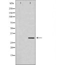 DF7183 at 1/100 staining Human breast cancer tissue by IHC-P. The sample was formaldehyde fixed and a heat mediated antigen retrieval step in citrate buffer was performed. The sample was then blocked and incubated with the antibody for 1.5 hours at 22¡ãC. An HRP conjugated goat anti-rabbit antibody was used as the secondary
