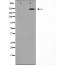 DF7193 at 1/100 staining Human breast cancer tissue by IHC-P. The sample was formaldehyde fixed and a heat mediated antigen retrieval step in citrate buffer was performed. The sample was then blocked and incubated with the antibody for 1.5 hours at 22¡ãC. An HRP conjugated goat anti-rabbit antibody was used as the secondary