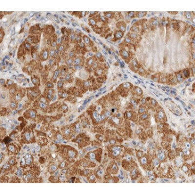 AF0108 at 1/100 staining human liver carcinoma tissue sections by IHC-P. The tissue was formaldehyde fixed and a heat mediated antigen retrieval step in citrate buffer was performed. The tissue was then blocked and incubated with the antibody for 1.5 hours at 22¡ãC. An HRP conjugated goat anti-rabbit antibody was used as the secondary