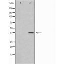 DF7222 at 1/100 staining Human breast cancer tissue by IHC-P. The sample was formaldehyde fixed and a heat mediated antigen retrieval step in citrate buffer was performed. The sample was then blocked and incubated with the antibody for 1.5 hours at 22¡ãC. An HRP conjugated goat anti-rabbit antibody was used as the secondary