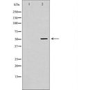 DF7227 at 1/100 staining Human liver cancer tissue by IHC-P. The sample was formaldehyde fixed and a heat mediated antigen retrieval step in citrate buffer was performed. The sample was then blocked and incubated with the antibody for 1.5 hours at 22¡ãC. An HRP conjugated goat anti-rabbit antibody was used as the secondary