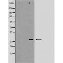 DF7246 at 1/100 staining Human breast cancer tissue by IHC-P. The sample was formaldehyde fixed and a heat mediated antigen retrieval step in citrate buffer was performed. The sample was then blocked and incubated with the antibody for 1.5 hours at 22¡ãC. An HRP conjugated goat anti-rabbit antibody was used as the secondary