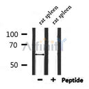 DF7262 at 1/100 staining Human brain cancer tissue by IHC-P. The sample was formaldehyde fixed and a heat mediated antigen retrieval step in citrate buffer was performed. The sample was then blocked and incubated with the antibody for 1.5 hours at 22¡ãC. An HRP conjugated goat anti-rabbit antibody was used as the secondary