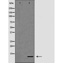 DF7277 at 1/100 staining Human urothelial cancer tissue by IHC-P. The sample was formaldehyde fixed and a heat mediated antigen retrieval step in citrate buffer was performed. The sample was then blocked and incubated with the antibody for 1.5 hours at 22¡ãC. An HRP conjugated goat anti-rabbit antibody was used as the secondary