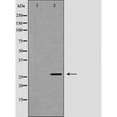 DF7303 at 1/100 staining Human breast cancer tissue by IHC-P. The sample was formaldehyde fixed and a heat mediated antigen retrieval step in citrate buffer was performed. The sample was then blocked and incubated with the antibody for 1.5 hours at 22¡ãC. An HRP conjugated goat anti-rabbit antibody was used as the secondary