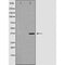 DF7310 at 1/100 staining Human urothelial cancer tissue by IHC-P. The sample was formaldehyde fixed and a heat mediated antigen retrieval step in citrate buffer was performed. The sample was then blocked and incubated with the antibody for 1.5 hours at 22¡ãC. An HRP conjugated goat anti-rabbit antibody was used as the secondary