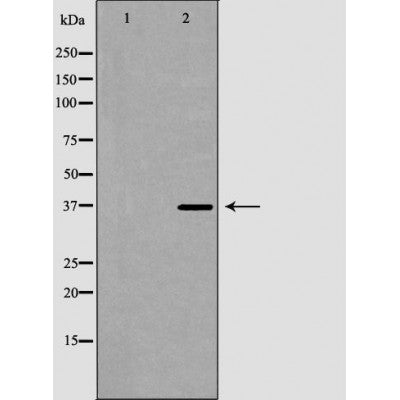 DF7310 at 1/100 staining Human urothelial cancer tissue by IHC-P. The sample was formaldehyde fixed and a heat mediated antigen retrieval step in citrate buffer was performed. The sample was then blocked and incubated with the antibody for 1.5 hours at 22¡ãC. An HRP conjugated goat anti-rabbit antibody was used as the secondary