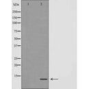 DF7316 at 1/100 staining Human Head and neck cancer tissue by IHC-P. The sample was formaldehyde fixed and a heat mediated antigen retrieval step in citrate buffer was performed. The sample was then blocked and incubated with the antibody for 1.5 hours at 22¡ãC. An HRP conjugated goat anti-rabbit antibody was used as the secondary