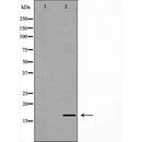 DF7357 at 1/100 staining Human breast cancer tissue by IHC-P. The sample was formaldehyde fixed and a heat mediated antigen retrieval step in citrate buffer was performed. The sample was then blocked and incubated with the antibody for 1.5 hours at 22¡ãC. An HRP conjugated goat anti-rabbit antibody was used as the secondary