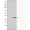 DF7360 at 1/100 staining Human breast cancer tissue by IHC-P. The sample was formaldehyde fixed and a heat mediated antigen retrieval step in citrate buffer was performed. The sample was then blocked and incubated with the antibody for 1.5 hours at 22¡ãC. An HRP conjugated goat anti-rabbit antibody was used as the secondary