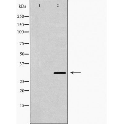 DF7360 at 1/100 staining Human breast cancer tissue by IHC-P. The sample was formaldehyde fixed and a heat mediated antigen retrieval step in citrate buffer was performed. The sample was then blocked and incubated with the antibody for 1.5 hours at 22¡ãC. An HRP conjugated goat anti-rabbit antibody was used as the secondary