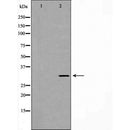 DF7361 at 1/100 staining Human breast cancer tissue by IHC-P. The sample was formaldehyde fixed and a heat mediated antigen retrieval step in citrate buffer was performed. The sample was then blocked and incubated with the antibody for 1.5 hours at 22¡ãC. An HRP conjugated goat anti-rabbit antibody was used as the secondary