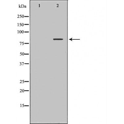 DF7379 at 1/100 staining Human urothelial cancer tissue by IHC-P. The sample was formaldehyde fixed and a heat mediated antigen retrieval step in citrate buffer was performed. The sample was then blocked and incubated with the antibody for 1.5 hours at 22¡ãC. An HRP conjugated goat anti-rabbit antibody was used as the secondary