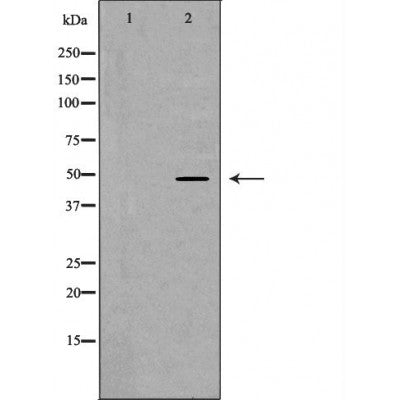 DF7405 at 1/100 staining Human liver cancer tissue by IHC-P. The sample was formaldehyde fixed and a heat mediated antigen retrieval step in citrate buffer was performed. The sample was then blocked and incubated with the antibody for 1.5 hours at 22¡ãC. An HRP conjugated goat anti-rabbit antibody was used as the secondary