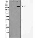 DF7407 at 1/100 staining Human brain cancer tissue by IHC-P. The sample was formaldehyde fixed and a heat mediated antigen retrieval step in citrate buffer was performed. The sample was then blocked and incubated with the antibody for 1.5 hours at 22¡ãC. An HRP conjugated goat anti-rabbit antibody was used as the secondary