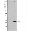 DF7417 at 1/100 staining Human breast cancer tissue by IHC-P. The sample was formaldehyde fixed and a heat mediated antigen retrieval step in citrate buffer was performed. The sample was then blocked and incubated with the antibody for 1.5 hours at 22¡ãC. An HRP conjugated goat anti-rabbit antibody was used as the secondary