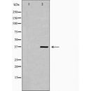 DF7420 at 1/100 staining Human liver cancer tissue by IHC-P. The sample was formaldehyde fixed and a heat mediated antigen retrieval step in citrate buffer was performed. The sample was then blocked and incubated with the antibody for 1.5 hours at 22¡ãC. An HRP conjugated goat anti-rabbit antibody was used as the secondary