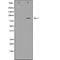 DF7446 at 1/100 staining Human liver cancer tissue by IHC-P. The sample was formaldehyde fixed and a heat mediated antigen retrieval step in citrate buffer was performed. The sample was then blocked and incubated with the antibody for 1.5 hours at 22¡ãC. An HRP conjugated goat anti-rabbit antibody was used as the secondary