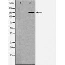 DF7454 at 1/100 staining Human brain cancer tissue by IHC-P. The sample was formaldehyde fixed and a heat mediated antigen retrieval step in citrate buffer was performed. The sample was then blocked and incubated with the antibody for 1.5 hours at 22¡ãC. An HRP conjugated goat anti-rabbit antibody was used as the secondary