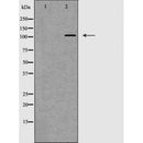 DF7456 at 1/100 staining Human urothelial cancer tissue by IHC-P. The sample was formaldehyde fixed and a heat mediated antigen retrieval step in citrate buffer was performed. The sample was then blocked and incubated with the antibody for 1.5 hours at 22¡ãC. An HRP conjugated goat anti-rabbit antibody was used as the secondary