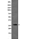 DF2200 at 1/100 staining Human liver cancer tissue by IHC-P. The sample was formaldehyde fixed and a heat mediated antigen retrieval step in citrate buffer was performed. The sample was then blocked and incubated with the antibody for 1.5 hours at 22¡ãC. An HRP conjugated goat anti-rabbit antibody was used as the secondary