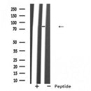 DF2225 at 1/100 staining Human urothelial cancer tissue by IHC-P. The sample was formaldehyde fixed and a heat mediated antigen retrieval step in citrate buffer was performed. The sample was then blocked and incubated with the antibody for 1.5 hours at 22¡ãC. An HRP conjugated goat anti-rabbit antibody was used as the secondary