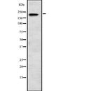 DF2241 at 1/100 staining Human liver cancer tissue by IHC-P. The sample was formaldehyde fixed and a heat mediated antigen retrieval step in citrate buffer was performed. The sample was then blocked and incubated with the antibody for 1.5 hours at 22¡ãC. An HRP conjugated goat anti-rabbit antibody was used as the secondary