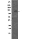 DF2294 at 1/100 staining Human liver cancer tissue by IHC-P. The sample was formaldehyde fixed and a heat mediated antigen retrieval step in citrate buffer was performed. The sample was then blocked and incubated with the antibody for 1.5 hours at 22¡ãC. An HRP conjugated goat anti-rabbit antibody was used as the secondary