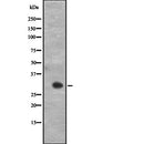 DF2296 at 1/100 staining Human urothelial cancer tissue by IHC-P. The sample was formaldehyde fixed and a heat mediated antigen retrieval step in citrate buffer was performed. The sample was then blocked and incubated with the antibody for 1.5 hours at 22¡ãC. An HRP conjugated goat anti-rabbit antibody was used as the secondary