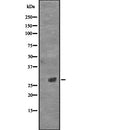 DF2301 at 1/100 staining Human urothelial cancer tissue by IHC-P. The sample was formaldehyde fixed and a heat mediated antigen retrieval step in citrate buffer was performed. The sample was then blocked and incubated with the antibody for 1.5 hours at 22¡ãC. An HRP conjugated goat anti-rabbit antibody was used as the secondary