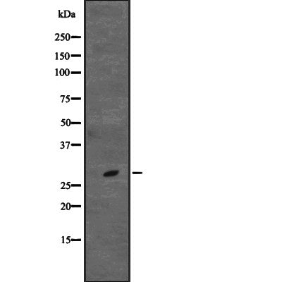 DF2302 at 1/100 staining Human liver cancer tissue by IHC-P. The sample was formaldehyde fixed and a heat mediated antigen retrieval step in citrate buffer was performed. The sample was then blocked and incubated with the antibody for 1.5 hours at 22¡ãC. An HRP conjugated goat anti-rabbit antibody was used as the secondary
