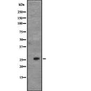 DF2305 at 1/100 staining Human urothelial cancer tissue by IHC-P. The sample was formaldehyde fixed and a heat mediated antigen retrieval step in citrate buffer was performed. The sample was then blocked and incubated with the antibody for 1.5 hours at 22¡ãC. An HRP conjugated goat anti-rabbit antibody was used as the secondary