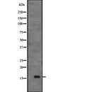 DF2318 at 1/100 staining Human breast cancer tissue by IHC-P. The sample was formaldehyde fixed and a heat mediated antigen retrieval step in citrate buffer was performed. The sample was then blocked and incubated with the antibody for 1.5 hours at 22¡ãC. An HRP conjugated goat anti-rabbit antibody was used as the secondary