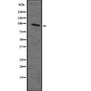DF2336 at 1/100 staining Human brain cancer tissue by IHC-P. The sample was formaldehyde fixed and a heat mediated antigen retrieval step in citrate buffer was performed. The sample was then blocked and incubated with the antibody for 1.5 hours at 22¡ãC. An HRP conjugated goat anti-rabbit antibody was used as the secondary