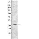 DF2498 at 1/100 staining Human urothelial cancer tissue by IHC-P. The sample was formaldehyde fixed and a heat mediated antigen retrieval step in citrate buffer was performed. The sample was then blocked and incubated with the antibody for 1.5 hours at 22¡ãC. An HRP conjugated goat anti-rabbit antibody was used as the secondary